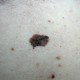 Schwarzer Hautkrebs (Melanom)