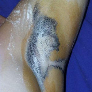 Schweißdrüsenentfernung (Hyperhidrosis)