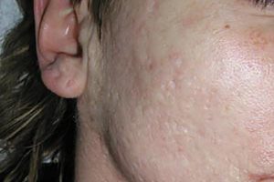 Behandlung von Akne | Hautarzt Dr. Hasert Berlin
