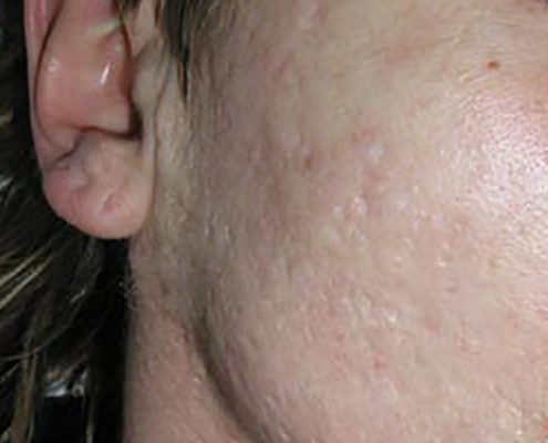 Behandlung von Akne | Hautarzt Dr. Hasert Berlin