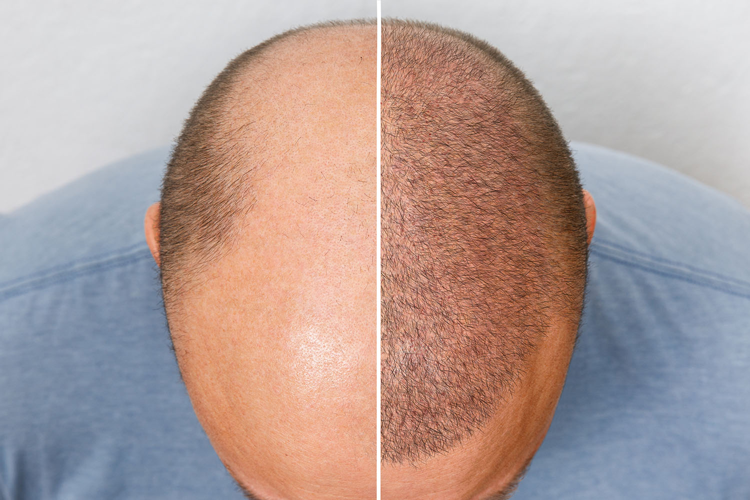 Haartransplantation | Hautarzt Dr. Raoul Hasert Berlin-Mitte